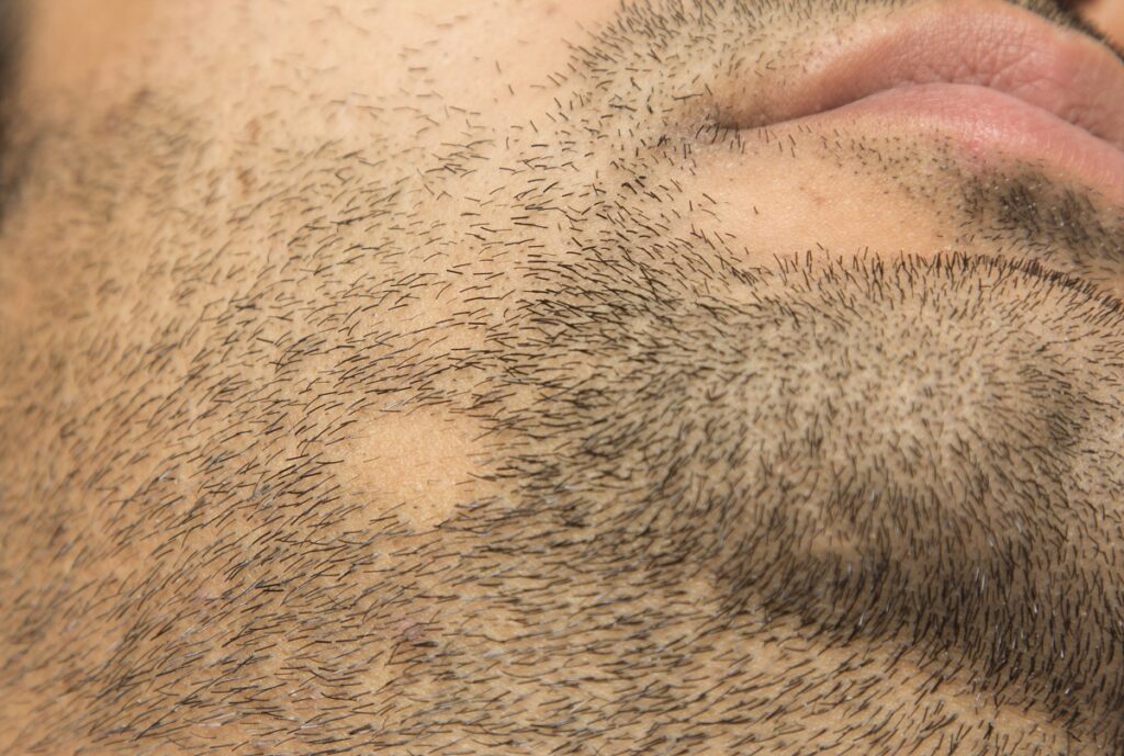 alopecia de barba